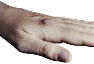 Seafood-associated mycobacterial infections