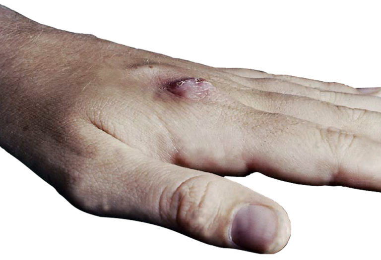 Article image for Seafood-associated mycobacterial infections