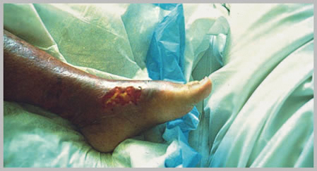Article image for Vibrio bacteria pose dangers for consumers, seafood workers