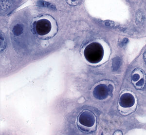 Genetic diversity of HPV parvovirus