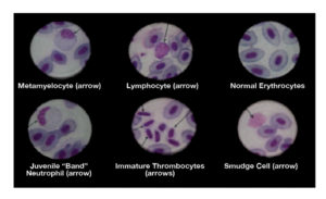 How to prepare and interpret blood smears